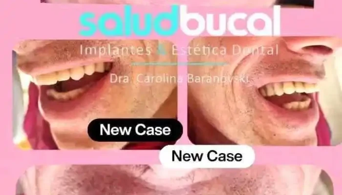 Implantes Dentales Montevideo Salud Bucal Odontologia Videos - Montevideo