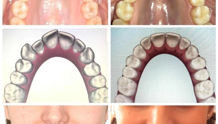 Invisalign -    Damon System   Ortodoncia Uruguay Del Propietario - Montevideo