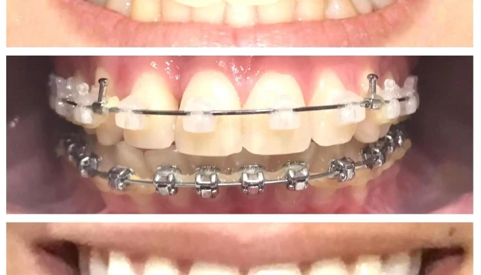 Invisalign -    Damon System   Ortodoncia Uruguay Diente - Montevideo