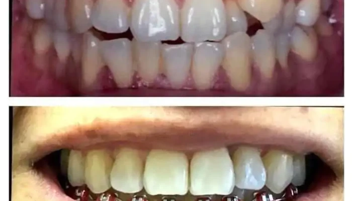 Maxima Cobertura Odontologica Diente - Montevideo