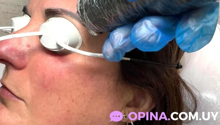 Tattoo Removal Uruguay By La Croix Clinic Del Propietario - Montevideo