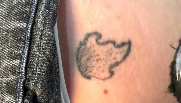 Tattoo Removal Uruguay By La Croix Clinic Videos - Montevideo
